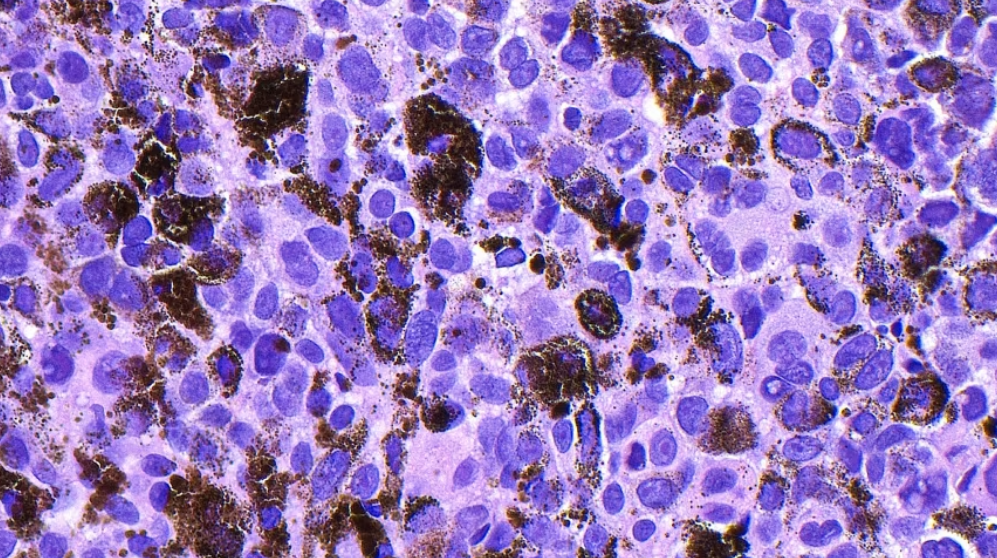 Experimental mRNA Cancer Vaccine Cuts Melanoma Recurrence Risk by 42%
